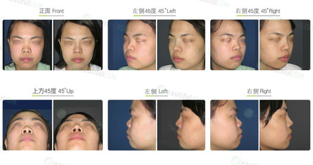 自体软骨隆鼻的缺点