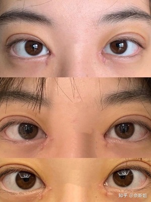割双眼皮后怎么去淤血