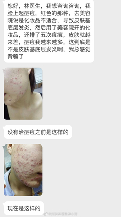 美容院能治疗痘痘吗