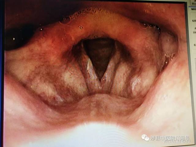 喉咙里面有白点是怎么回事