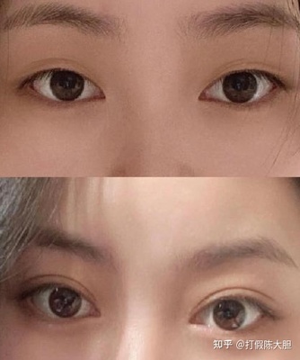 割一双眼皮多少钱