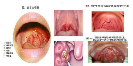 喉咙充血是怎么回事