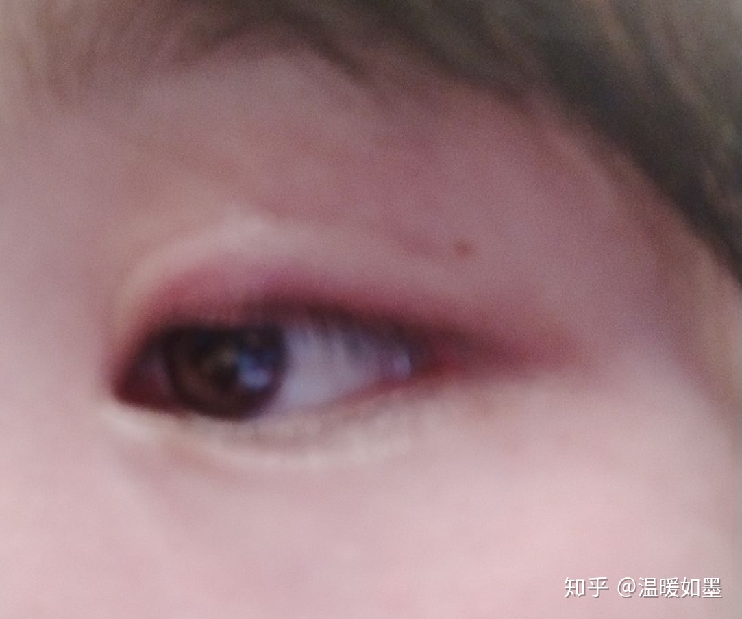 眼睛疼又肿是怎么回事