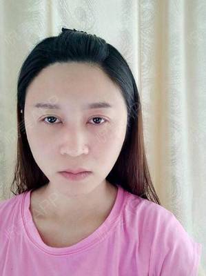 脂肪填充后下巴长痘痘