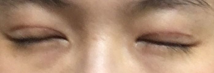 割了双眼皮多久可以碰水