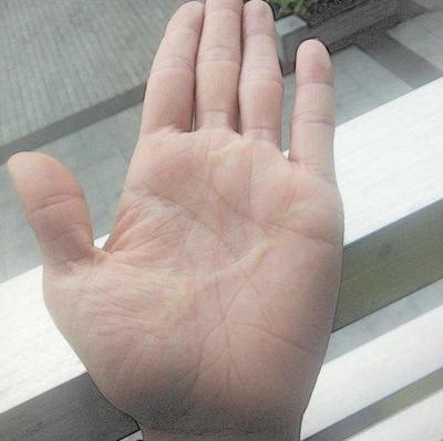 手掌疤痕