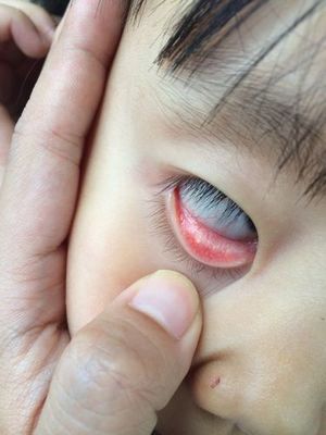 眼睛有白斑是怎么回事