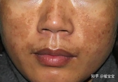 长痘痘去看皮肤科