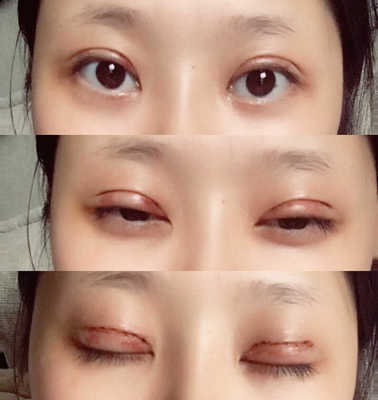 双眼皮结痂多久掉