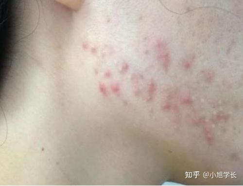 淋巴排毒后长痘痘