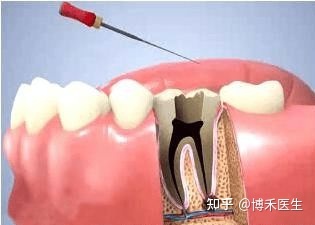 牙齿发炎怎么治疗