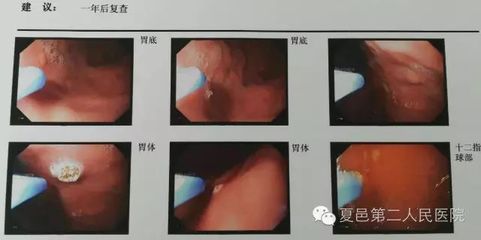 胃粘连怎么治疗方法