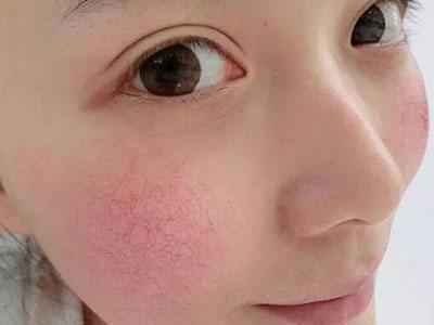 脸经常红是怎么回事