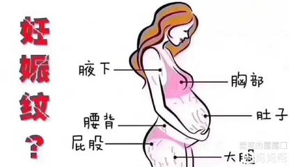 孕妇长妊娠纹的原因