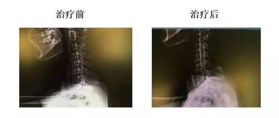 颈椎反张怎么治疗