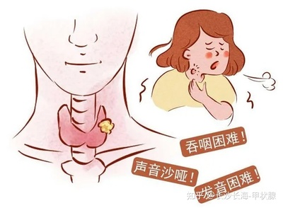 甲状腺能引起咳嗽吗