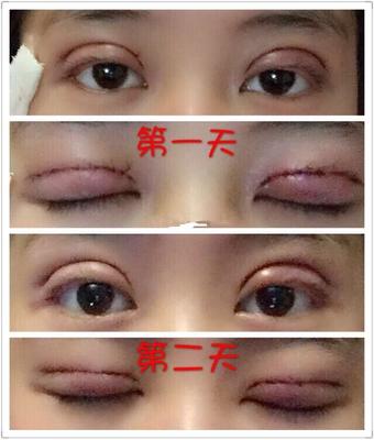 全切双眼皮忌口