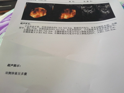 多囊怀孕