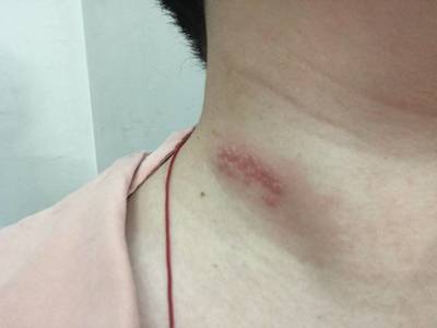 孕妇脖子上长痘痘怎么办