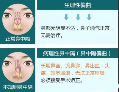鼻中隔偏曲怎么治疗