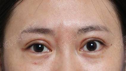 眼部肿胀
