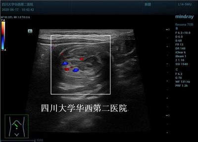 肠套叠是怎么回事