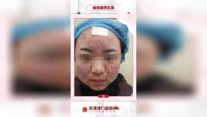 天津痘痘应搜_津门