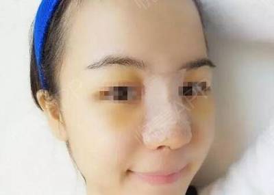 隆鼻后眼睛周围有淤青
