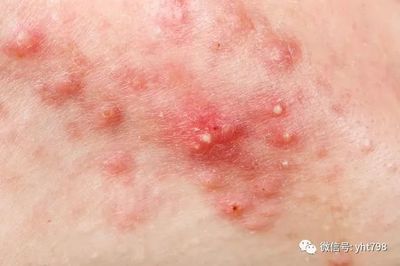上火 痘痘 为什么