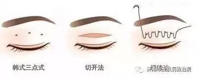 点式双眼皮