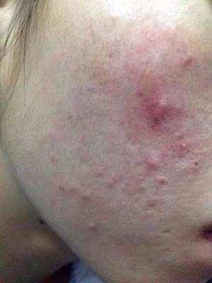 长痘痘什么不能吃