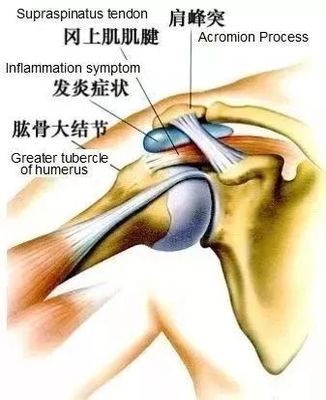肩关节疼痛怎么治疗
