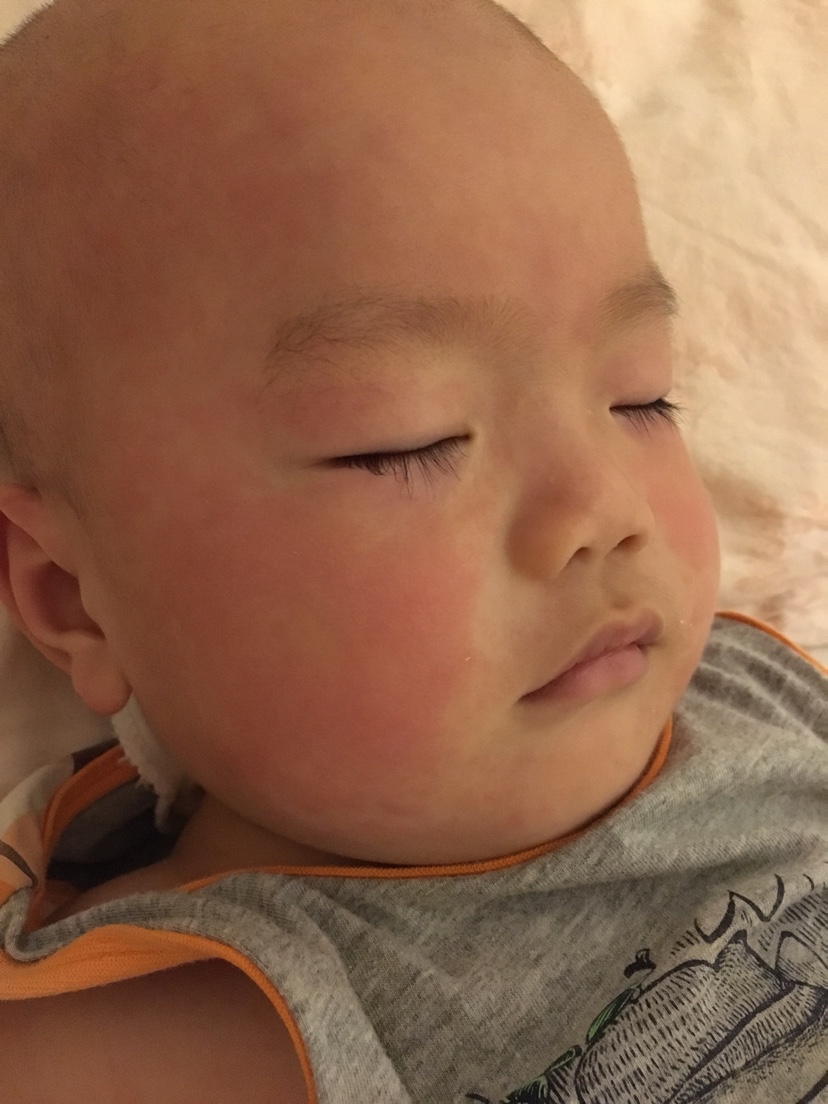 小孩脸上长小红点是怎么回事