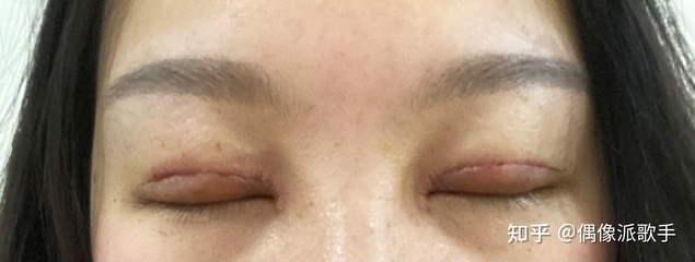 割了双眼皮多久可以碰水