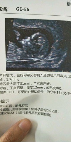 12周胎儿nt值正常范围