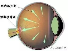 眼睛眼压高是怎么回事