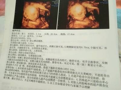 侧脑室宽说明胎儿聪明