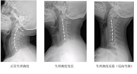 颈椎反张怎么治疗