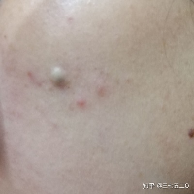 粉瘤和痘痘的区别