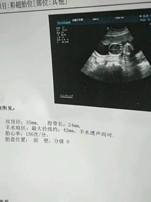 梦见孕妇羊水破了