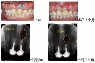 根尖瘘管手术多少钱