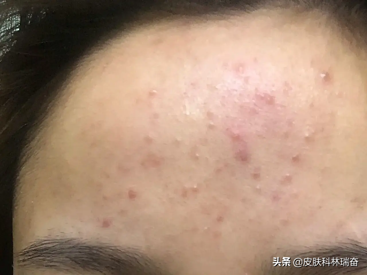 痘痘反复不好怎么办啊