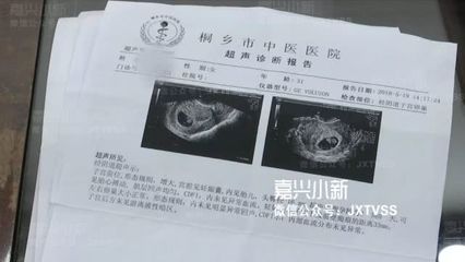 结扎三年了还会怀孕吗