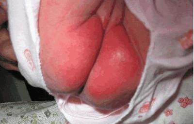 宝宝屁股溃烂怎么办