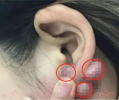 耳朵上长小痘痘
