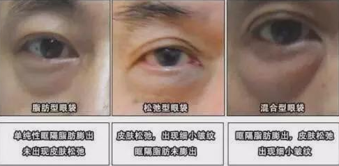 怎么治疗大眼袋
