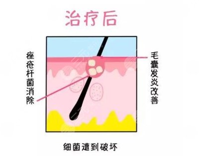 红蓝光祛痘副作用