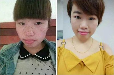 痘痘肌可以用蜂蜜敷脸吗