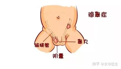 男孩隐睾是怎么回事