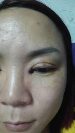 双眼皮结痂多久掉